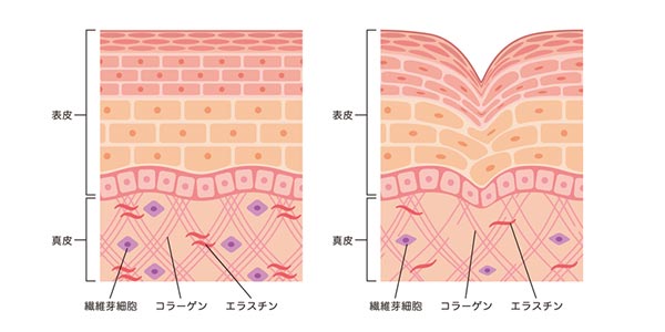 加齢による皮下組織と皮膚の変化